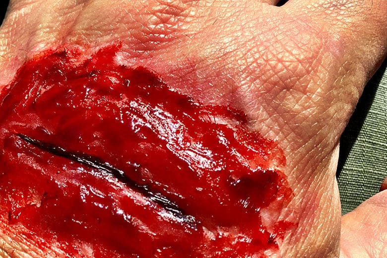 Critical Skills For Treating Injuries And Wounds In A Survival Situation